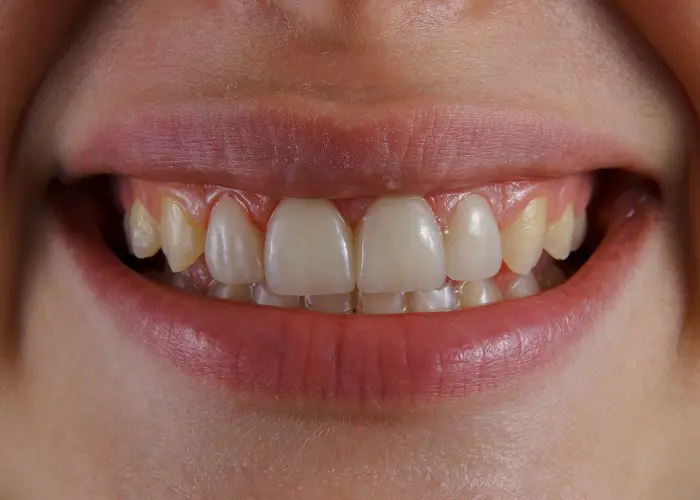 Dental Implant Patients